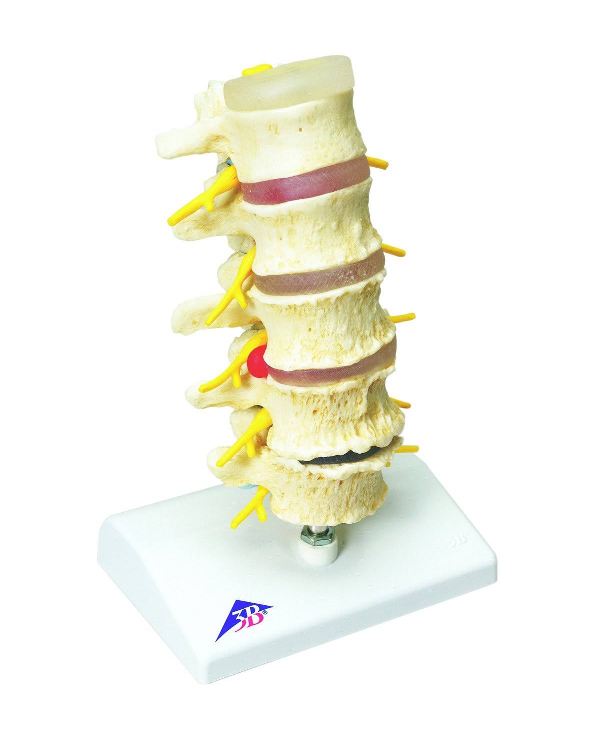 Vertebrae Degeneration Anatomical Model H972